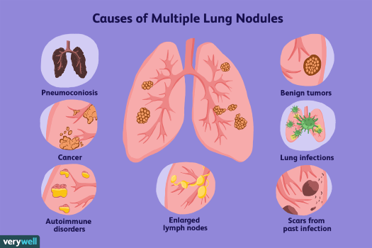 when to Worry About Lung Nodules